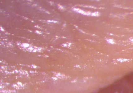 Pterygion (I USA ”Surfers eye”) där bindehinnan med blodkärl växer in som en vinge över hornhinnan. 